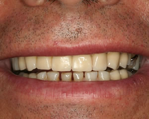 Warren Dental Full Reconstruction After