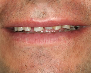 Warren Dental Full Reconstruction Before