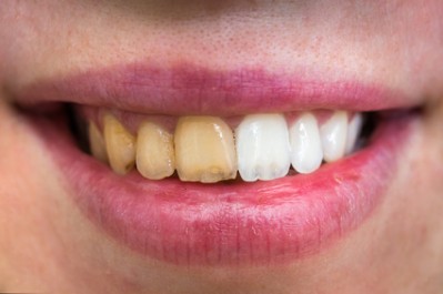 Considering Teeth Whitening for Upcoming Summer Events?