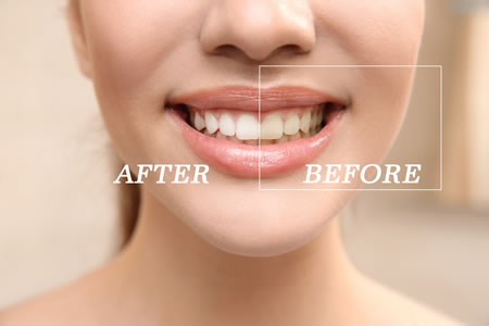 Teeth Whitening Tips - Dr Apsey, Warren, MI