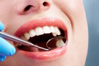 What are Dental Inlays and Onlays?
