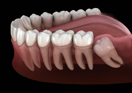 Dental Extraction - Impacted Wisdom Tooth